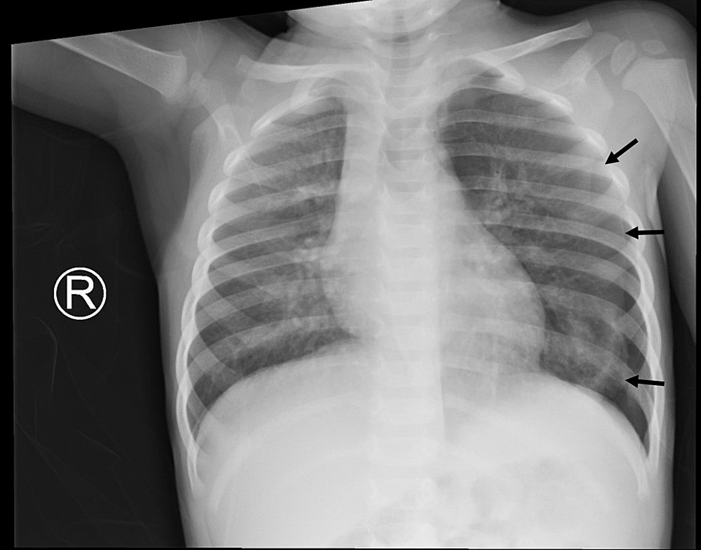 Foreign body inhalation_Table Image 6 Foreign body inhalation_Table Image 6